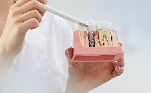 Model of dental implant